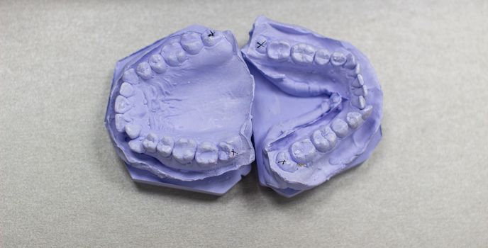 Plaster cast of teeth from plaster at the orthodontist. Model of the jaw and teeth for installing braces.