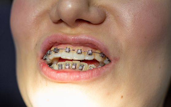 A woman with braces on her teeth visits an orthodontist, in a dental chair. during the procedure of installing the arch of braces on the upper and lower teeth. The girl smiles.The concept of dentistry