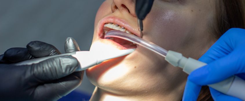 A woman with dental braces visits an orthodontist at the clinic. in the dental chair during the procedure of installing braces on the upper and lower teeth. Dentist and assistant work together, they have dental instruments in their hands. concept of dentistry