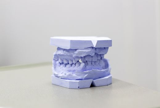 Plaster cast of teeth from plaster at the orthodontist. Model of the jaw and teeth for installing braces.