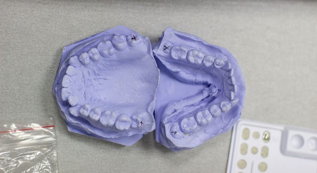 Plaster cast of teeth from plaster at the orthodontist. Model of the jaw and teeth for installing braces.