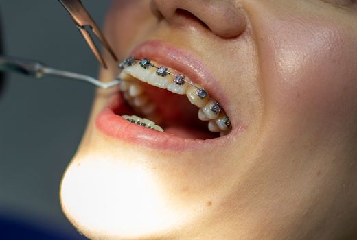 A woman with dental braces visits an orthodontist in the clinic, in a dental chair. during the procedure of installing the arch of braces on the upper and lower teeth. The dentist is wearing gloves and has dental instruments in his hands. The concept of dentistry