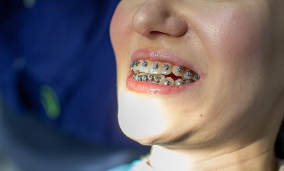 A woman with braces on her teeth visits an orthodontist, in a dental chair. during the procedure of installing the arch of braces on the upper and lower teeth. The girl smiles.The concept of dentistry