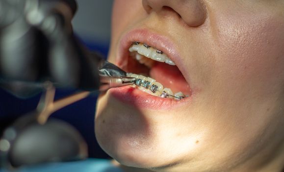 A woman with braces visits an orthodontist, in a dental chair. during the procedure of installing the arch of braces on the lower teeth. The dentist is wearing gloves and holding a pair of forceps. 