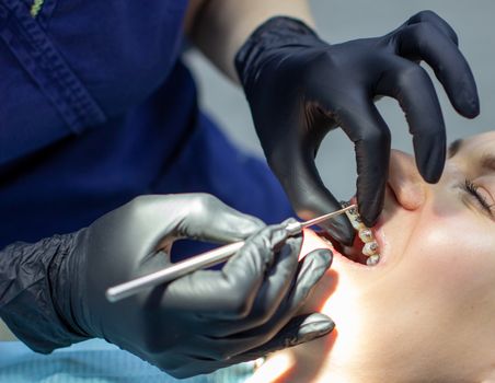 woman with braces visits an orthodontist, in a dental chair.during the procedure of installing the arch of braces on the upper and lower teeth.The dentist is wearing gloves and has tools in his hands.