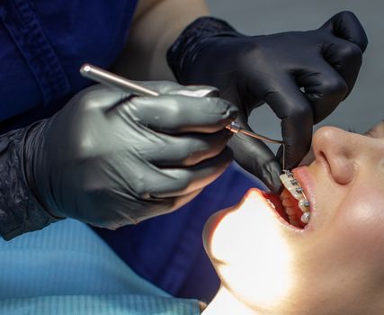 woman with braces visits an orthodontist, in a dental chair.during the procedure of installing the arch of braces on the upper and lower teeth.The dentist is wearing gloves and has tools in his hands.