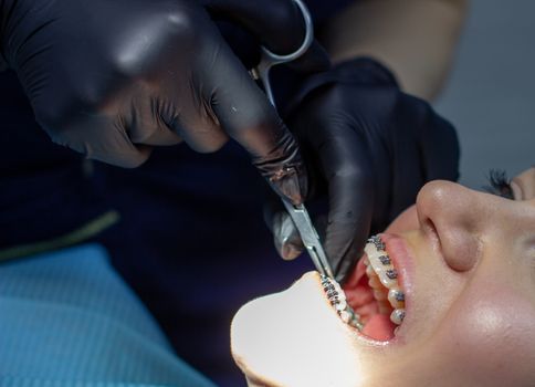 woman with braces visits an orthodontist, in a dental chair.during the procedure of installing the arch of braces on the upper and lower teeth.The dentist is wearing gloves and has tools in his hands.