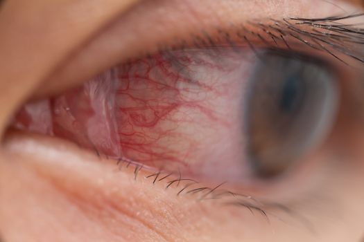Closeup of irritated or infected red bloodshot eye - conjunctivitis. Red eye of woman, conjunctivitis eye, allergy or after cry.