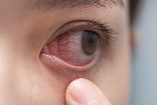 Closeup of irritated or infected red bloodshot eye - conjunctivitis. Red eye of woman, conjunctivitis eye, allergy or after cry.