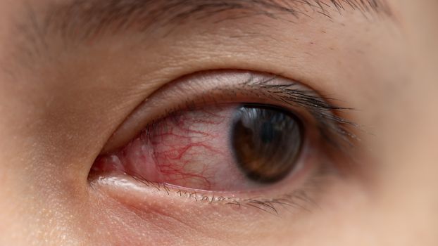 Closeup of irritated or infected red bloodshot eye - conjunctivitis. Red eye of woman, conjunctivitis eye, allergy or after cry.