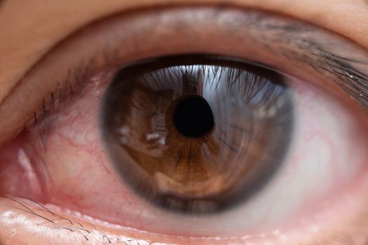 Closeup of irritated or infected red bloodshot eye - conjunctivitis. Red eye of woman, conjunctivitis eye, allergy or after cry.