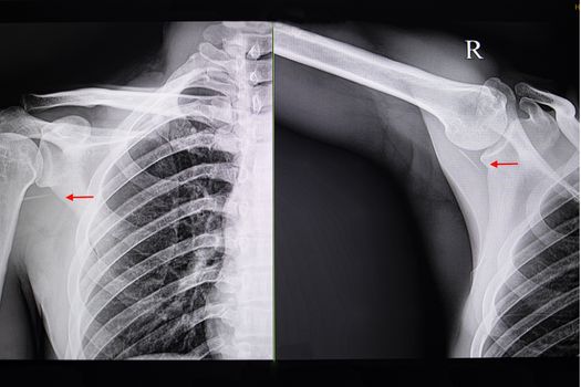 A chest xray film of a patient with lagre foreigh body (fish bone) retention in soft tissue of right shoulder from accidental punctate injury.