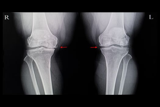 Xray film of a patient with both knees degenerative osteoarhthritis with spurs and joint space narrowing.