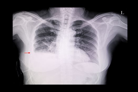 A chest x-ray film of a female patient with cardiomegaly, pulmonary edema and right lung pleural effusion.