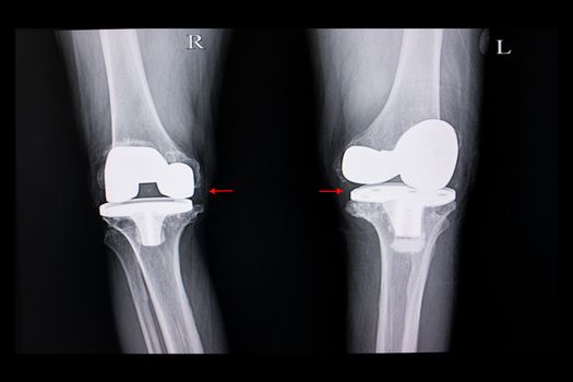 Xray film of a patient with both knees arthroplasty operation.