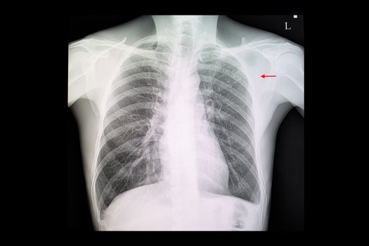 A chest x-ray film of a patient with pulmonary tuberculosis with fibronodular infiltration at left upper lung.