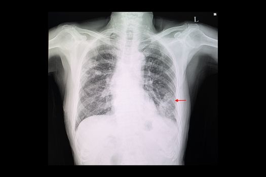 A chest x-ray film of a patient with left lower lung pneumonia and right upper lung nodules