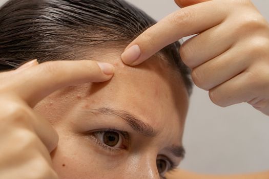 Close-up portrait of a girl squeezes out a pimple on her forehead. An awkward moment before a date.