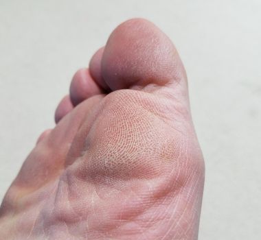 dry and flaky toes and ball and sole of foot