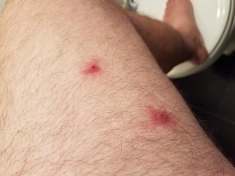 two red bites on a man's hairy leg in bathroom