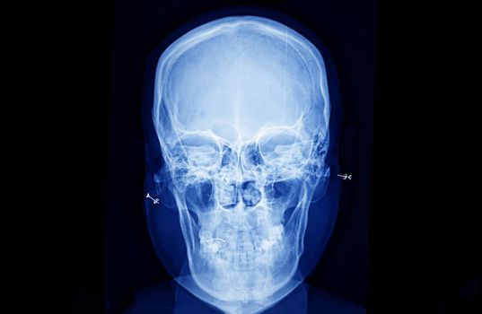 Film x-ray skull and cervical spine lateral view, X-Ray film of human bones from nose to chest.