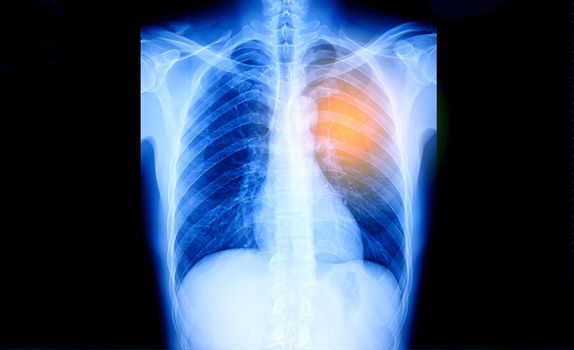 X-Ray Image Of Human Chest for a medical diagnosis, coronavirus or Covid-19 concept