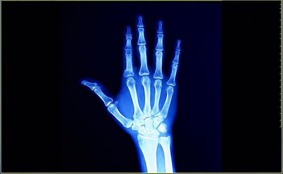 X-Ray film of human hand