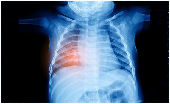 X-Ray Image Of Human Chest for a medical diagnosis, coronavirus or Covid-19 concept