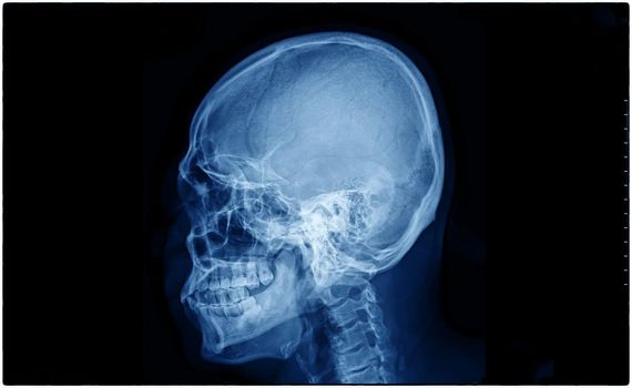 Film x-ray skull and cervical spine lateral view, X-Ray film of human bones from nose to chest.