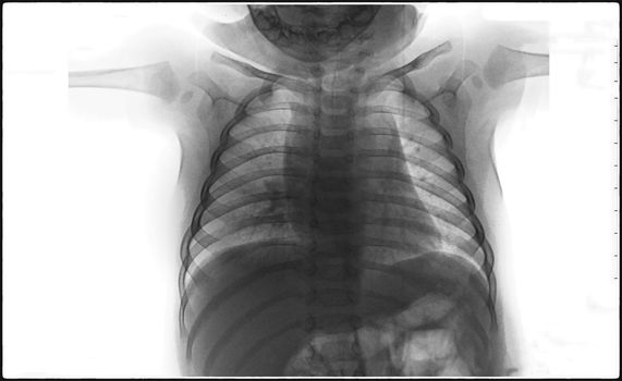 X-Ray Image Of Human Chest for a medical diagnosis, coronavirus or Covid-19 concept