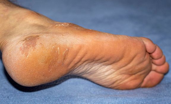 Heel disease with hard skin and itchy soles