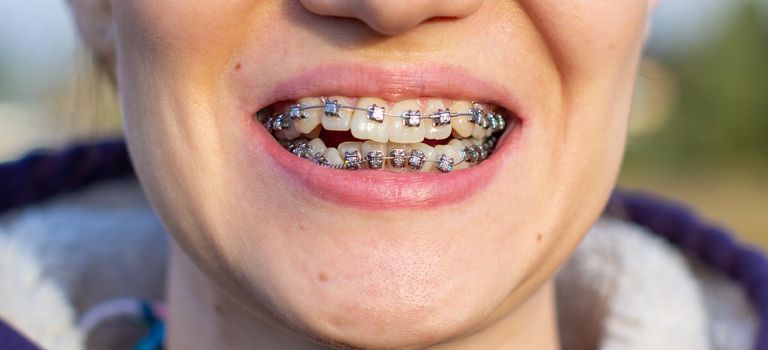 brasket system in smiling mouth, macro photo teeth, close-up lips, macro shot