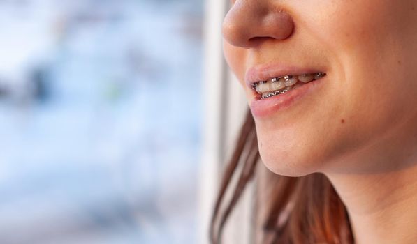 Brasket system in a girl's smiling mouth, macro photography of teeth. large face and painted lips. Braces on the teeth of a girl who smiles.