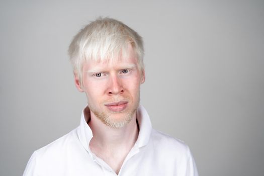 albinism albino man in studio dressed t-shirt isolated on a white background. abnormal deviations. unusual appearance. skin abnormality