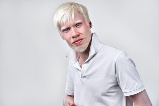 albinism albino man white skin hair studio dressed t-shirt isolated white background. abnormal deviations. unusual appearance. skin abnormality Beautiful people with special appearance. Eat banana
