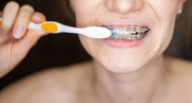 Girl with braces on her teeth brushing her teeth with a toothbrush, close-up. Dental and oral care. Braces for leveling teeth