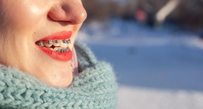 The girl has braces on her teeth. A girl in the winter on the street smiles and braces are visible on her teeth. Smooth teeth from the installation of braces