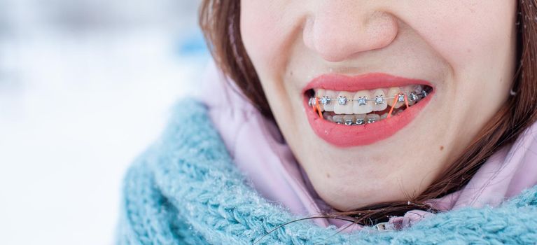 The girl has braces on her teeth. A girl in the winter on the street smiles and braces are visible on her teeth. On the zooms are colored elastic bands to tighten the teeth. Even teeth