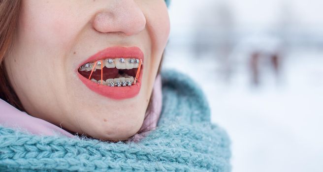 The girl has braces on her teeth. A girl in the winter on the street smiles and braces are visible on her teeth. On the zooms are colored elastic bands to tighten the teeth. Even teeth