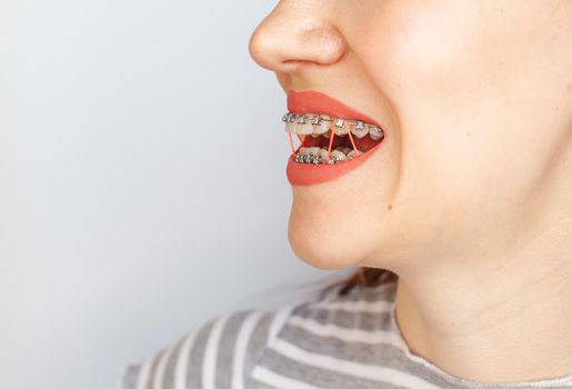 Braces in the smiling mouth of a girl. Close-up photos of teeth and lips. Smooth teeth from braces. On the teeth of elastic bands for tightening teeth. Photo on a light solid background.