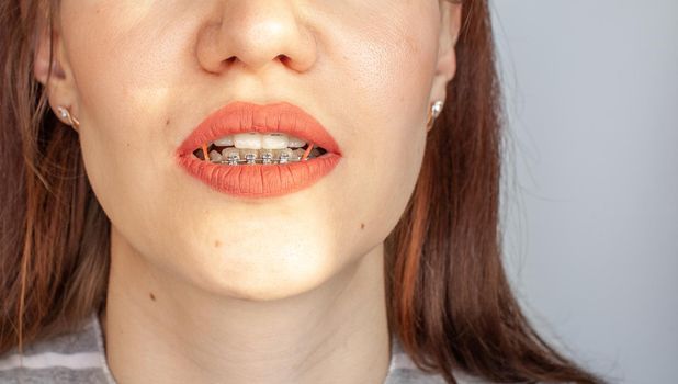 Braces in the smiling mouth of a girl. Close-up photos of teeth and lips. Smooth teeth from braces. On the teeth of elastic bands for tightening teeth. Photo on a light solid background.