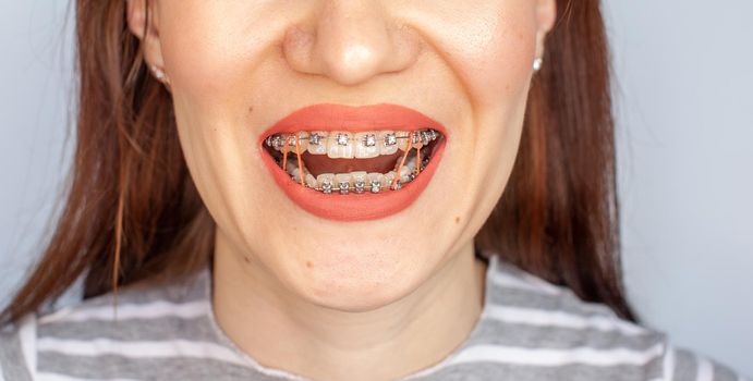 Braces in the smiling mouth of a girl. Close-up photos of teeth and lips. Smooth teeth from braces. On the teeth of elastic bands for tightening teeth. Photo on a light solid background.