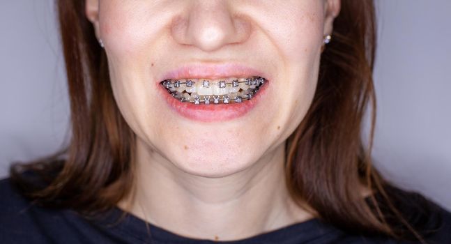 Braces in the smiling mouth of a girl. Close-up photos of teeth and lips. Smooth teeth from braces. On the teeth of elastic bands for tightening teeth. Photo on a light solid background.