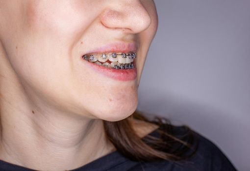 Braces in the smiling mouth of a girl. Close-up photos of teeth and lips. Smooth teeth from braces. On the teeth of elastic bands for tightening teeth. Photo on a light solid background.