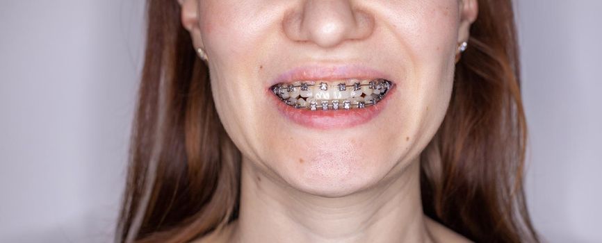 Braces in the smiling mouth of a girl. Close-up photos of teeth and lips. Smooth teeth from braces. On the teeth of elastic bands for tightening teeth. Photo on a light solid background.