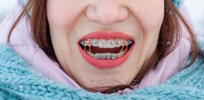 The girl has braces on her teeth. A girl in the winter on the street smiles and braces are visible on her teeth. On the zooms are colored elastic bands to tighten the teeth. Even teeth