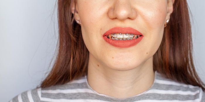 Braces in the smiling mouth of a girl. Close-up photos of teeth and lips. Smooth teeth from braces. On the teeth of elastic bands for tightening teeth. Photo on a light solid background.