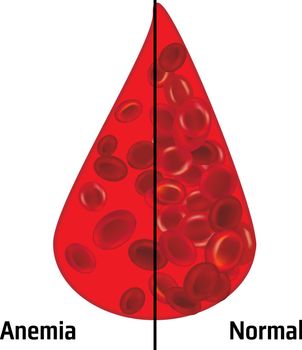Anemia and normal ammount of red blood cells in a drop of blood vector illustration