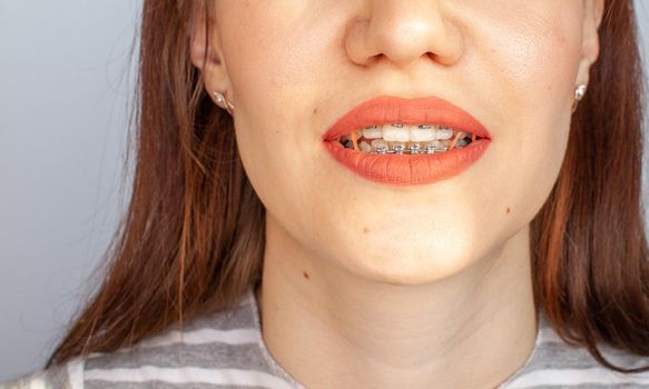 Braces in the smiling mouth of a girl. Close-up photos of teeth and lips. Smooth teeth from braces. On the teeth of elastic bands for tightening teeth. Photo on a light solid background.