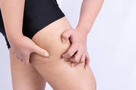Female holding and pushing the skin of the legs cellulite, orange peel. Treatment and disposal of excess weight, the deposition of subcutaneous fat tissue